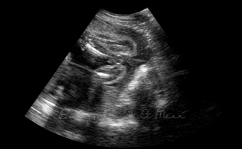 Ultraschall Outing Junge babykindundmeer